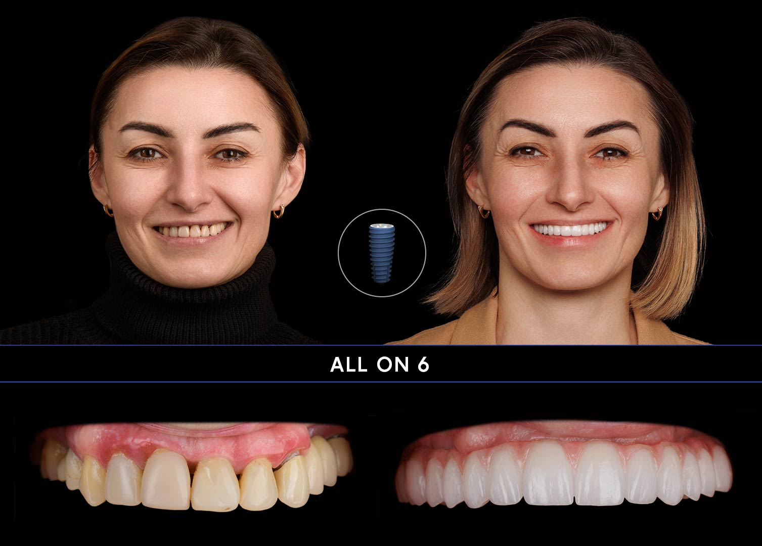 ALL-ON11