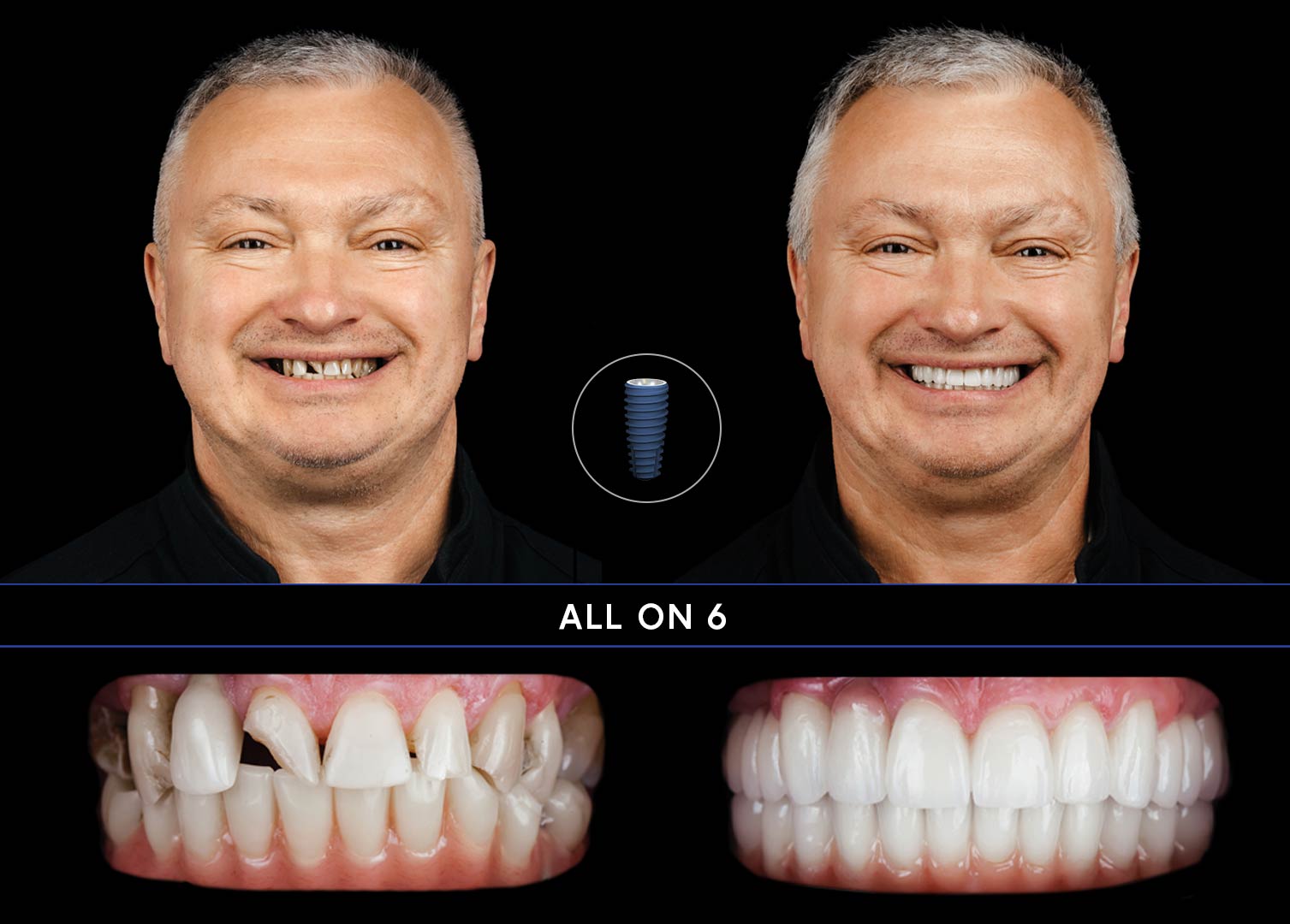 ALL-ON4