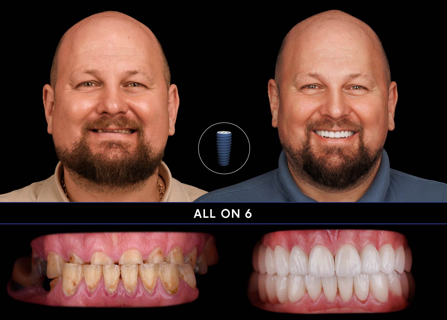 ALL-ON6