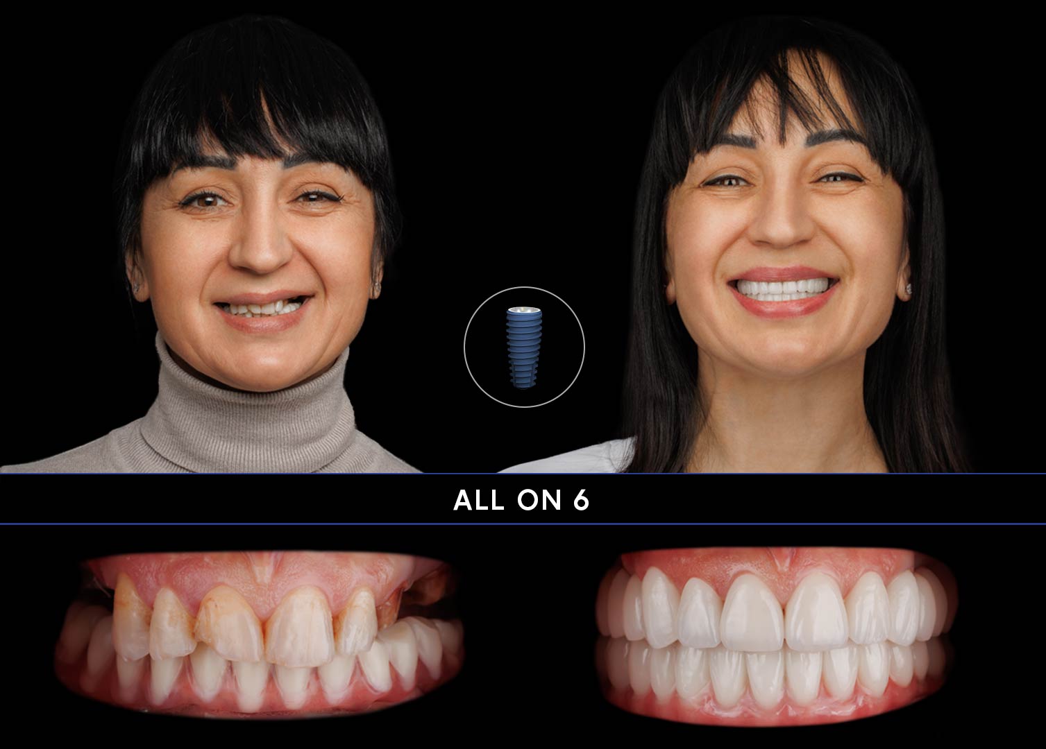 ALL-ON7